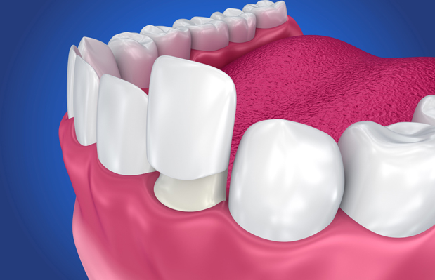 What Are Dental Crowns