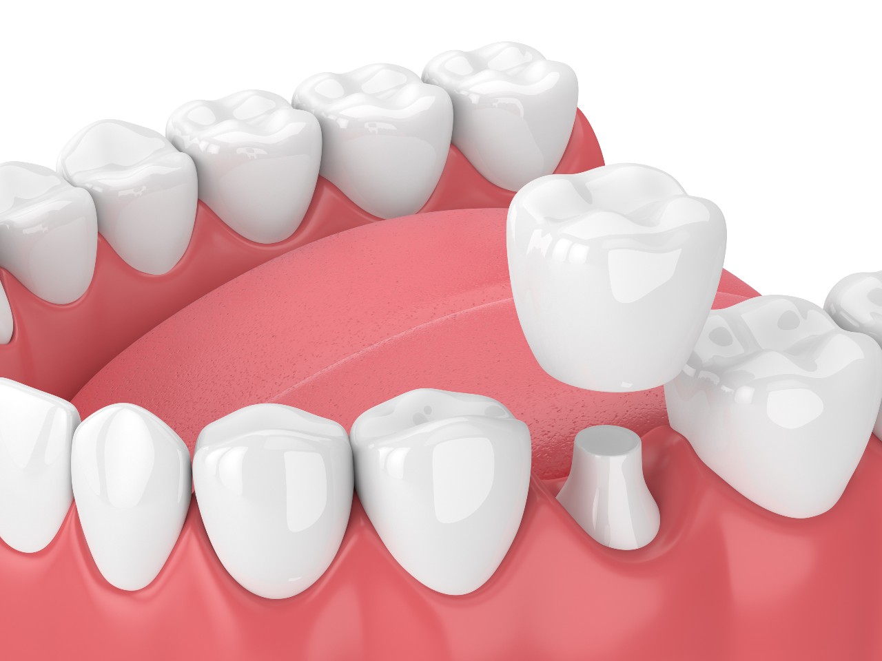 dental crowns