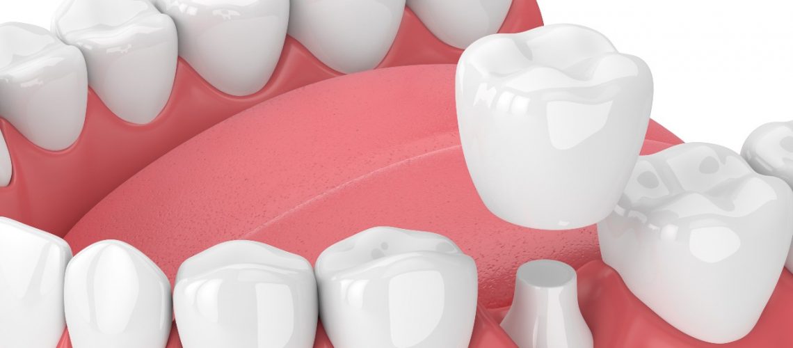 dental crowns